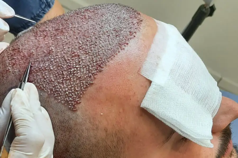 hair transplant pakistan